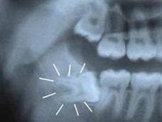 Tại sao bị đau nhức khi mọc răng khôn?
