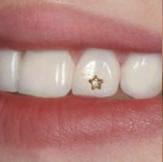 Gắn đá lên răng có hại gì cho răng không?