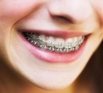 Có mấy loại niềng răng? Thế nào là niềng răng cố định và niềng răng tháo lắp